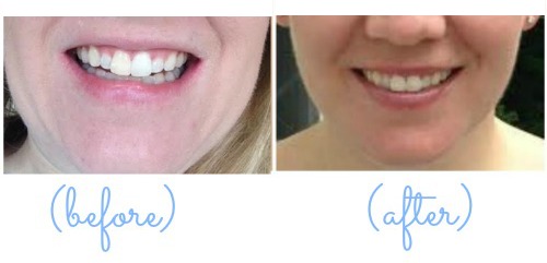 Smile-Brilliant-Before-After